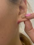 Красно-буряковое пятно на мочке уха фото 1