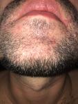 Воспаления кожи в области усов и подбородка фото 3