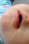 Припухлость с покраснением нижней губы у ребенка фото 1