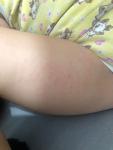 Аллергия/ дерматит у ребёнка фото 2