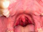 Может ли быть рак горла? фото 1