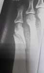 Перелом 5 плюсневой кости со смещением фото 1