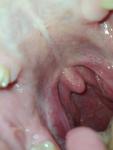 Опухоль миндалин, ком в горле фото 1