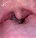 Как вылечить горло? Воспалена миндалина фото 1