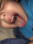 Воспаление языка у ребёнка, коричневый налёт фото 1
