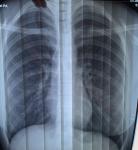 Помогите расшифровать рентген лёгких фото 1