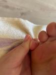 Облазит кожа на пальцах ног фото 4