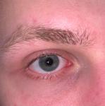 Белые точки на слезном мясце, возможно опухлость и краснота глаза фото 2