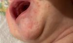 Высыпания на лице и груди у новорожденного фото 4