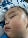Покраснение и сыпь на щеках у ребёнка 10 месяца фото 1