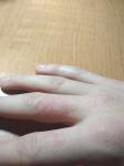 Покраснение и шелушение кожи на пальце руки фото 1