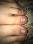 Темные пятнышки на костяшках пальцев ног фото 1