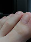 Округлые образования на пальцах ног, переходят на другие пальцы фото 1