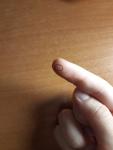 Маленькие ямочки на коже пальца фото 2
