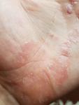 Заболевание кожи ладоней рук фото 1