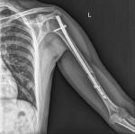 Срастание перелома плечевой кости фото 1