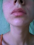 Сильное шелушение и стягивание кожи вокруг рта фото 1