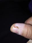 Небольшая болячка на пальце руки около ногтя фото 1