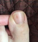 Коричневое пятно под ногтем большого пальца ноги фото 1