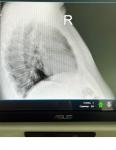 Правильно ли описан снимок рентген легких фото 2