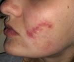 Воспаление на лице, шрам на лице фото 1