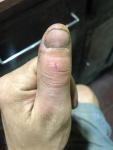 Очень сильно опух палец руки после глубокого пореза до кости фото 2