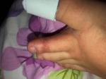 Сыпь на больших пальцах ног фото 2