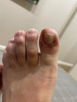 Покраснение и шелушение пальцев ног фото 1