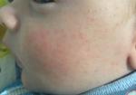 Высыпания на щеках 1,5 месяца ребёнку фото 1