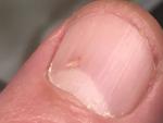 Проблема с ногтем большого пальца руки фото 2