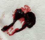 Выкидыш или обычный сгусток крови фото 1