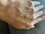 Мелкая сыпь на кисти руки фото 3