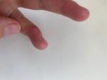 Зуд и трещины на пальцах рук фото 5
