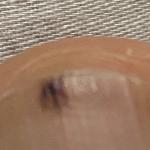 Пятно на ногтевой пластине ноги фото 2