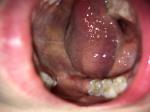 Прозрачные пузырьки на слизистой рта фото 1