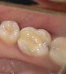 Ноющие боли зуба фото 2