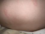 Красные пятна на спине ребенка фото 1