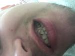 Разрушение зубов с лицевой стороны фото 3