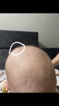 Костная шишка на голове у ребёнка фото 2