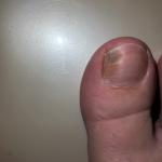 Появилось круглое пятно на пальце ноги фото 2