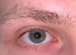 Белые точки на слезном мясце, возможно опухлость и краснота глаза фото 4