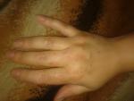 Опухла рука и появились красные пятна (типо больших веснушек) фото 1