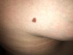 Папиллома на груди во время беременности фото 2