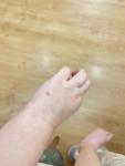 Болячка сухая на руке у малыша фото 3