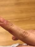 Проблема с кожей у пальцев рук фото 2