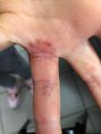 Проблема с кожей на пальцах на среднем и безымянных пальцах фото 1