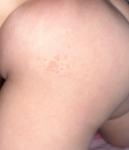 Сыпь телесного цвета у ребенка фото 2