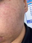 Аллергия красные маленькие точки на лице фото 2