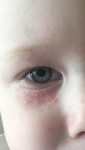 Аллергия, герпес фото 2
