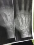 3 палец пястной кости сломан фото 1
